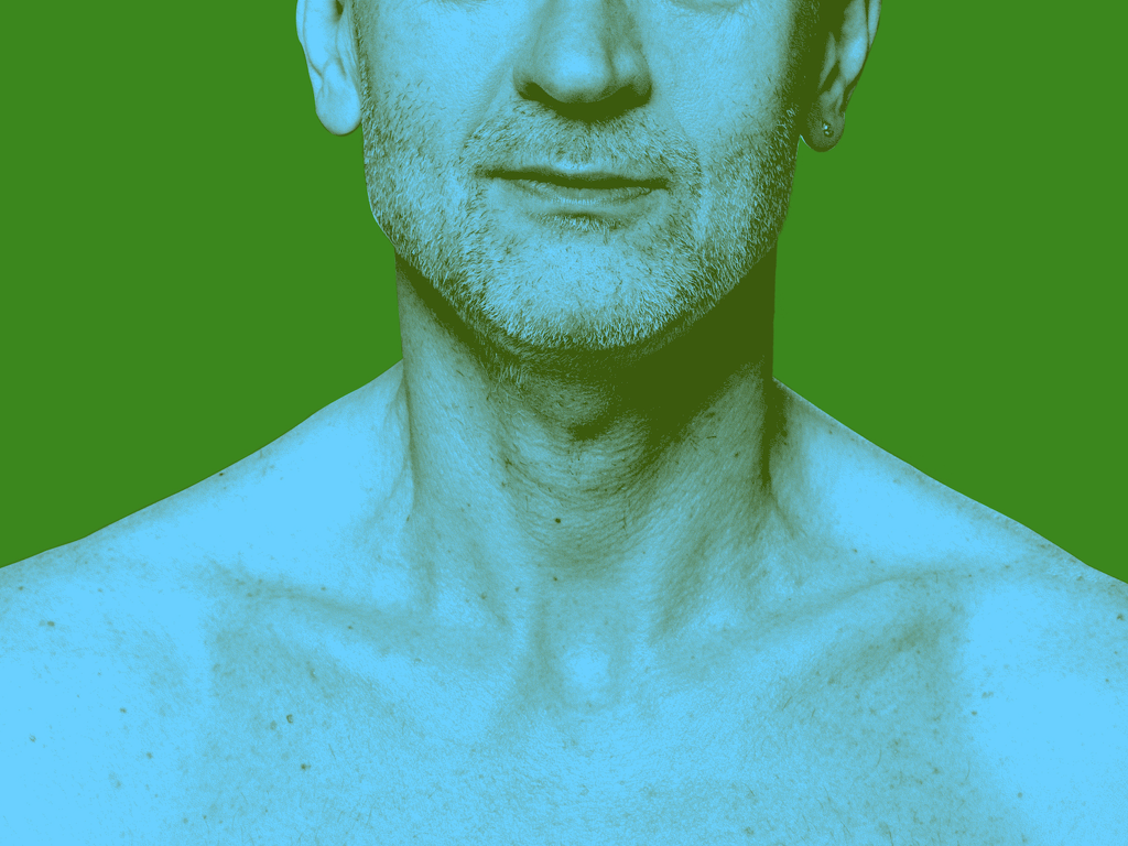 Myasthenia Gravis