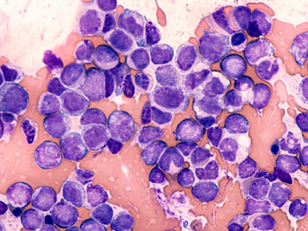 JJ Photo Blast Cells From Acute Myeloid Leukemia AML Shutterstock 574965784 1Star