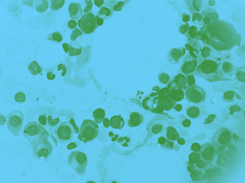 Multiple Myeloma